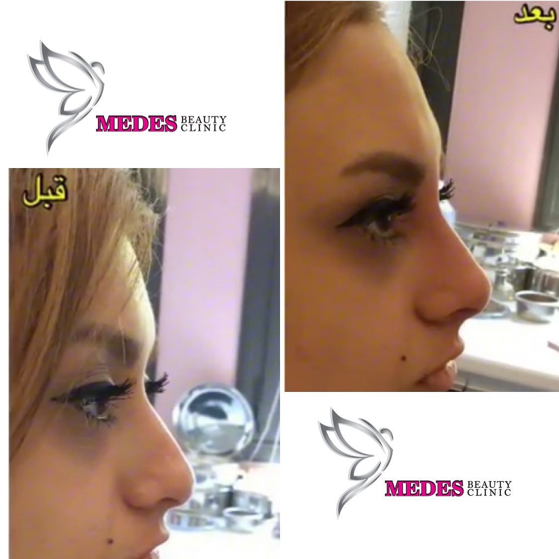 گالری لیفت با نخ